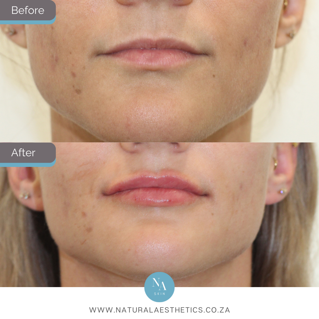 Before-and-After-Lip-Filler-Treatment-Using-Restylane-Kysse-Results-By-Dr-Aimee-Gericke