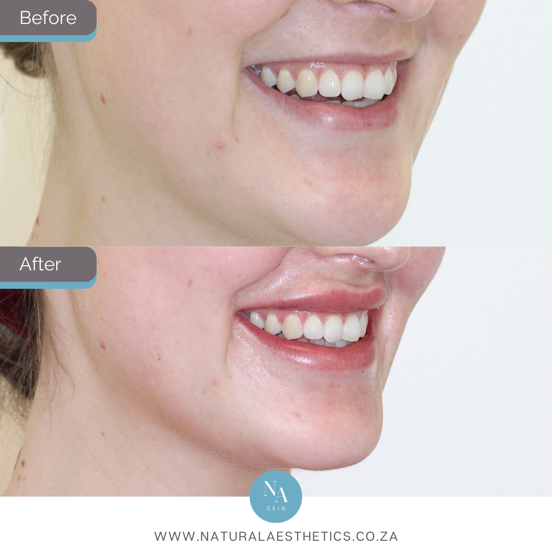 Before-and-After-Lip-Filler-Treatment-Using-Restylane-Kysse-Results-By-Dr-Melinda-Dommisse