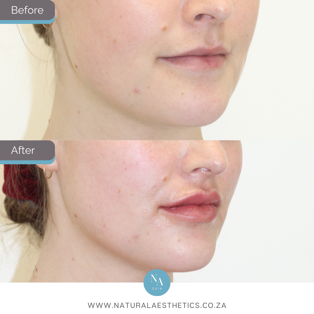 Before-and-After-Lip-Filler-Treatment-With-Restylane-Kysse-Results-By-Dr-Melinda-Dommisse