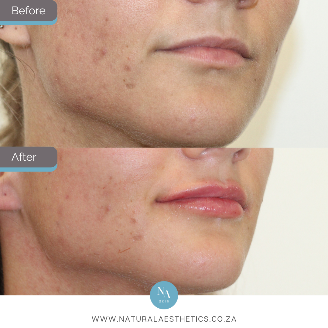 Before-and-After-Lip-Filler-With-Results-By-Dr-Aimee-Gericke