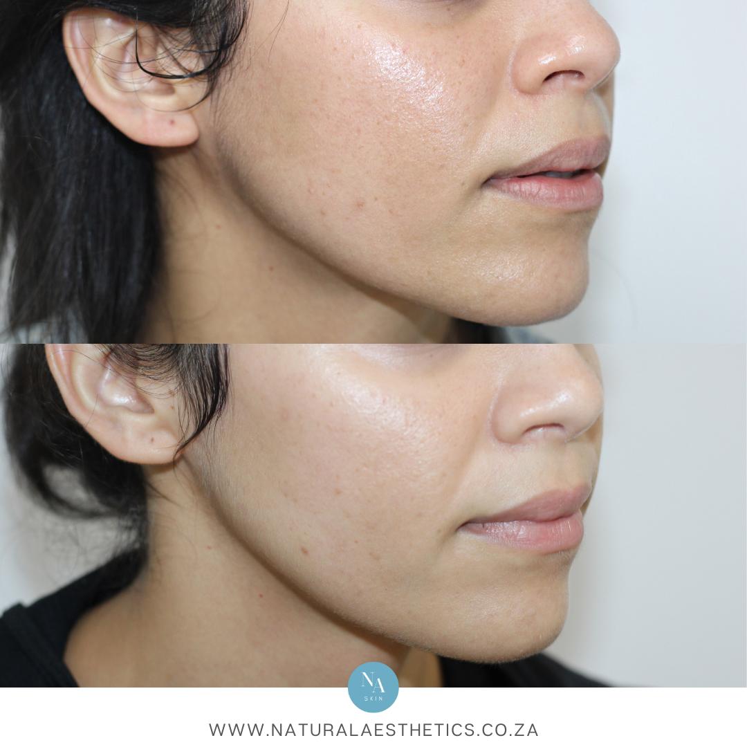 Before and after results Dermapen microneedling For Pigmentation and Scarring
