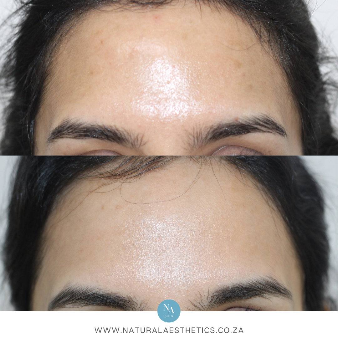 Before and after results Dermapen microneedling at Natural Aesthetics Cape Town