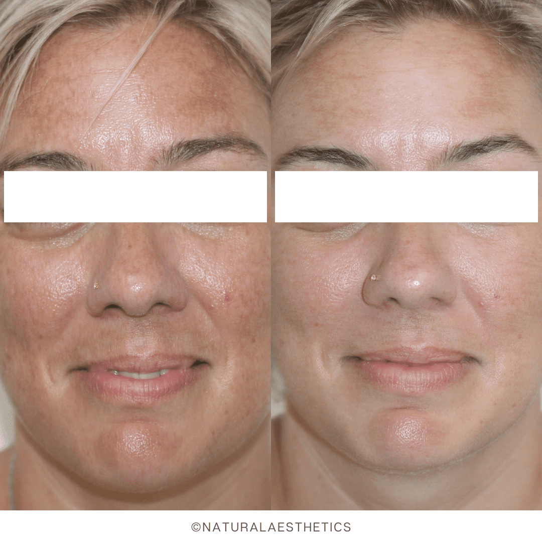 Skin Dermapen Microneedling Treatment Dermapen Microneedling Pen