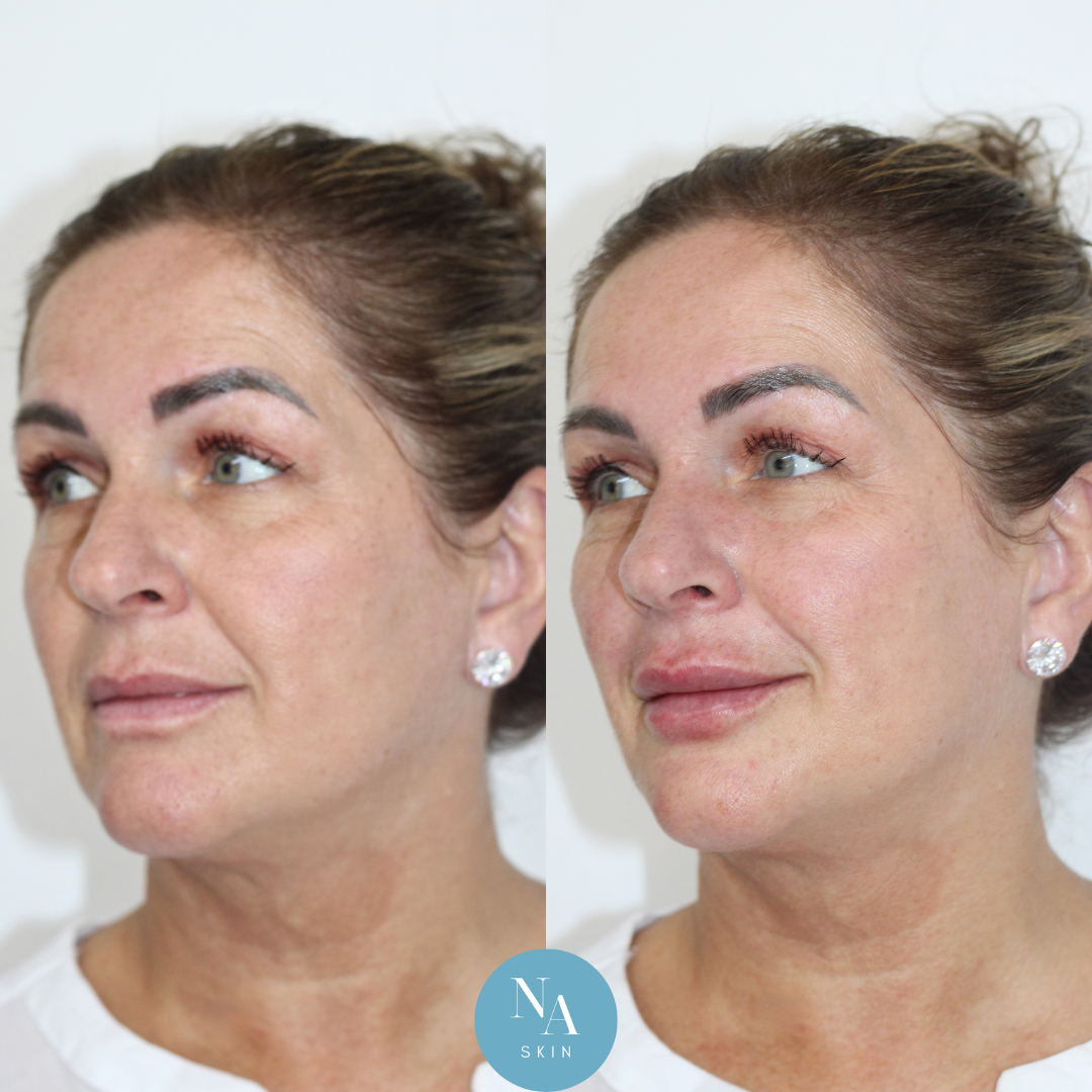 Lip-Filler-Treatment-Using-Restylane-Kysse-Results-By-Dr-Wade-Merchant