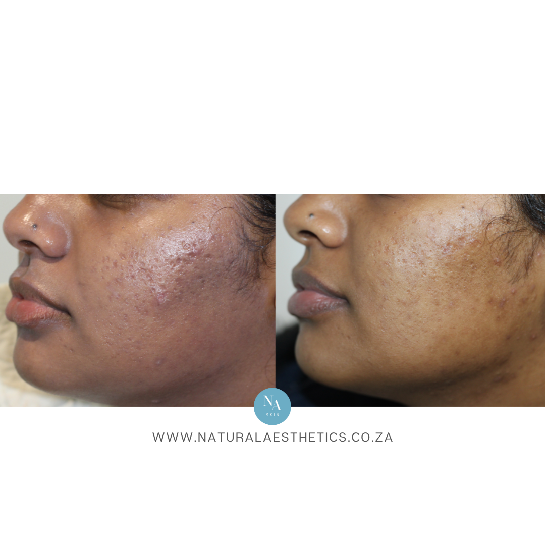 Before-and-after-Venus-Viva-NanoFractional-RF-Cape-Town