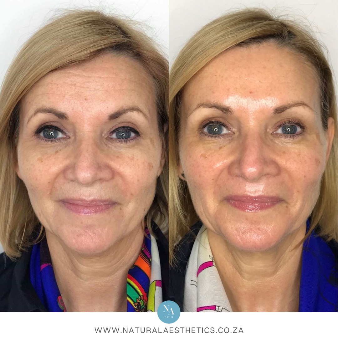 Venus-Viva-Treatments-Results