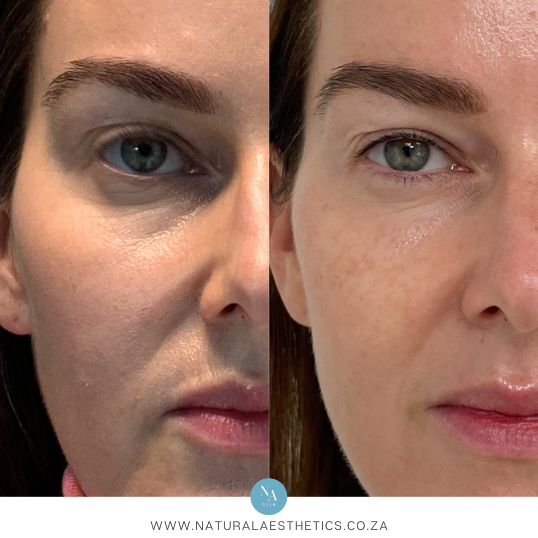 Venus-Versa-NanoFractional-Radio-Frequency-Before-and-After-Results