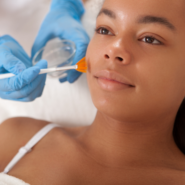 Chemical-Peel-Treatment