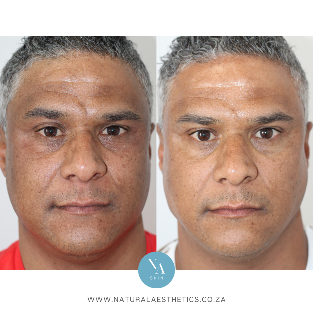 Before-After-Chemical Peel-Cape Town