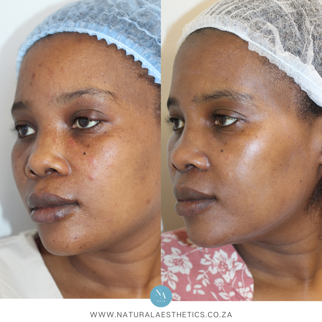 Before-After-Chemical Peel-Cape Town